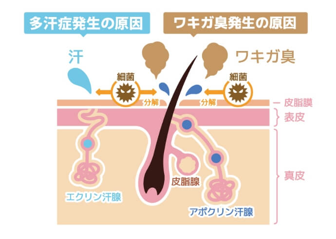 わきが・多汗症の原因やメカニズム