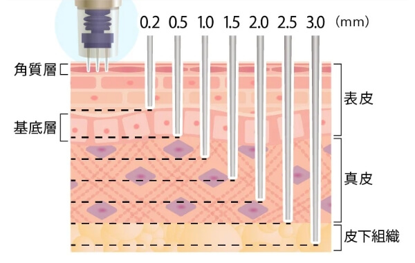 痛み・腫れが少ない