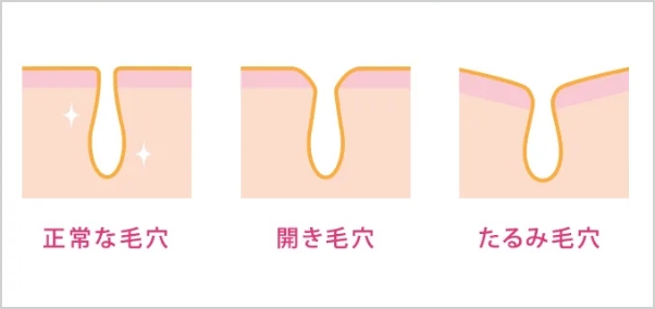 ニキビ跡・色素沈着