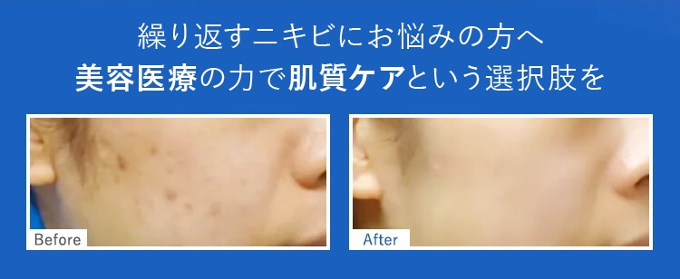 基礎化粧品や洗顔で治らないニキビは美容医療で解決！