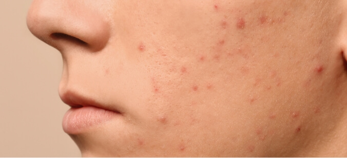 ニキビ改善の注意点について