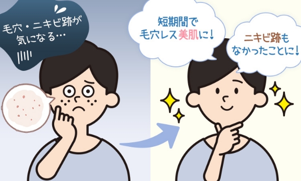 ニキビケア・再発予防