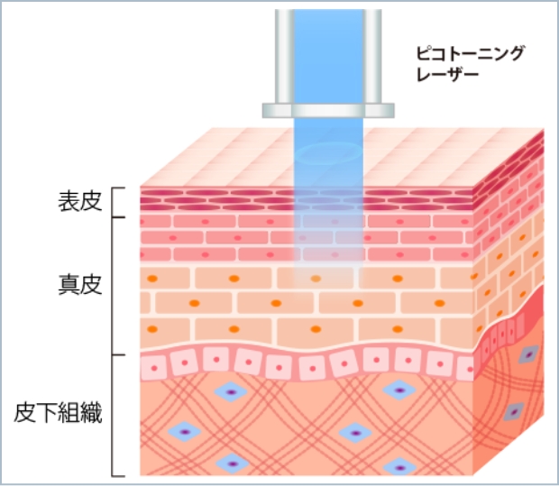 ピコトーニング