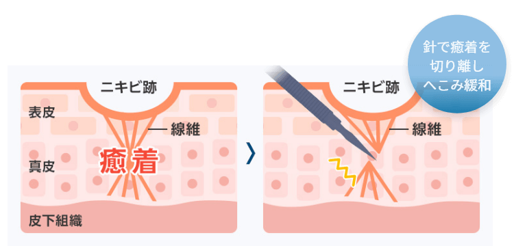 針で癒着を切り離しへこみ緩和