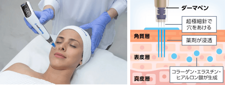 ダーマーペンとは