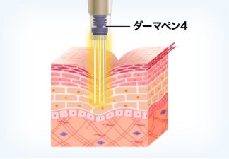 細い極細針で、お肌の真皮層に垂直に微細の穴をあける