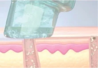 吸引により表皮の汚れを浮かせ毛穴の奥まで洗浄。同時に保湿も行います。