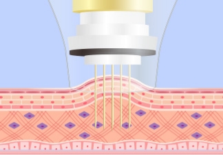 皮膚が押し上げられ針を正確に挿入