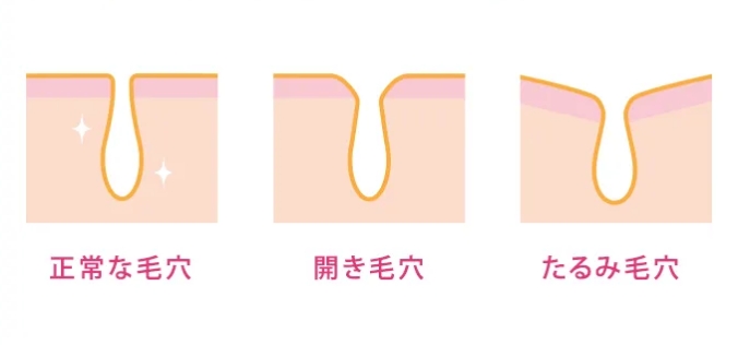 ニキビ跡・色素沈着の改善