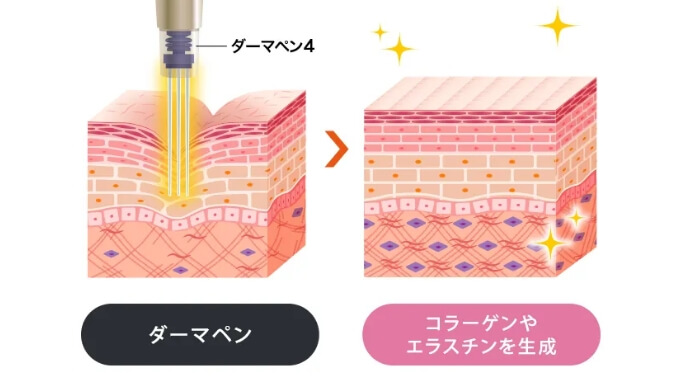 肌の弾力・小じわ改善