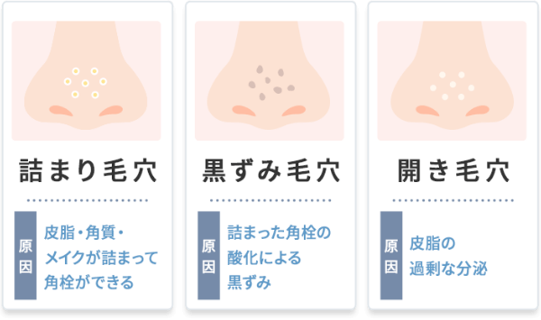 毛穴の症状と原因に合わせた適切な治療