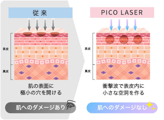 ピコレーザーの仕組み