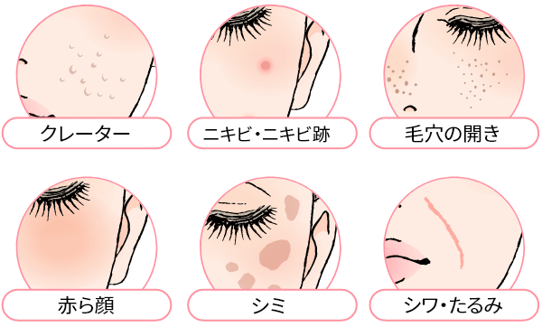 あらゆる肌悩みに1度の施術で変化期待