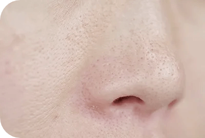 ニキビ跡・肌の凹凸・毛穴の開き改善