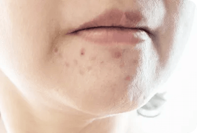 ニキビの根本治療・再発防止