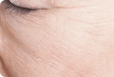 お肌の再生、若返り治療