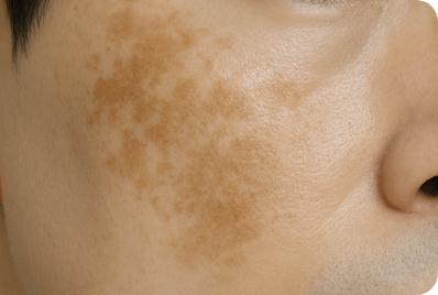 肝斑の根本治療・予防