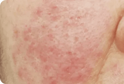 赤ら顔(酒さ・紅潮)