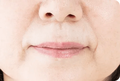 たるみ・小じわ改善