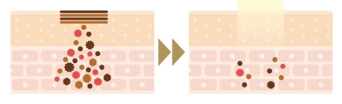 IPL光治療の施術イメージ