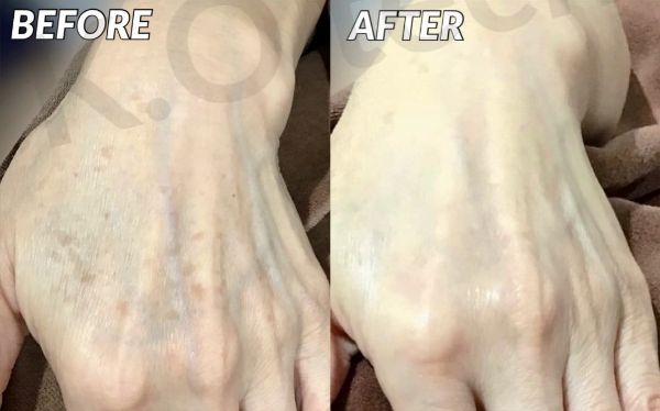 IPL治療(手の甲)