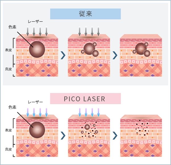 01 ピコトーニング