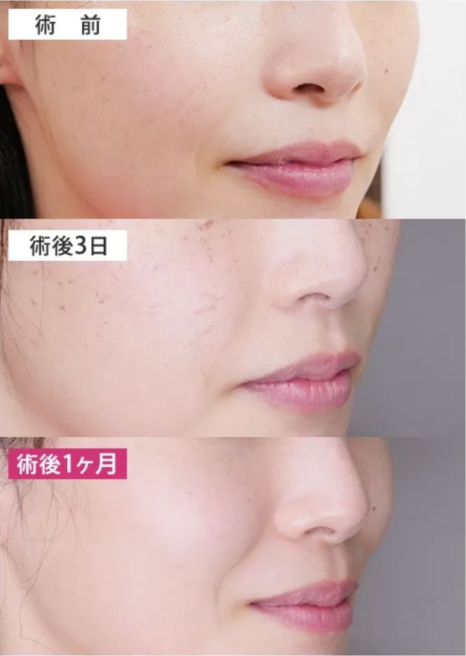 ピコレーザー治療経過