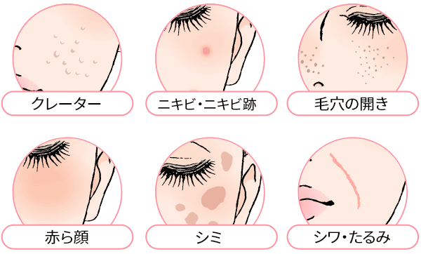 あらゆる肌悩みに1度の施術で変化期待