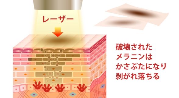 レーザーによってメラニン色素にアプローチし、治療効果が期待されます。