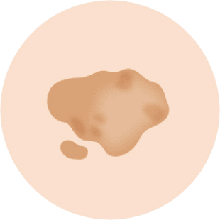 老人性色素班(日光性シミ)