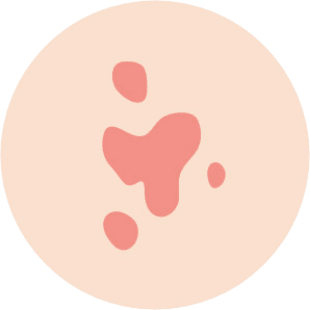 ニキビ跡の赤み