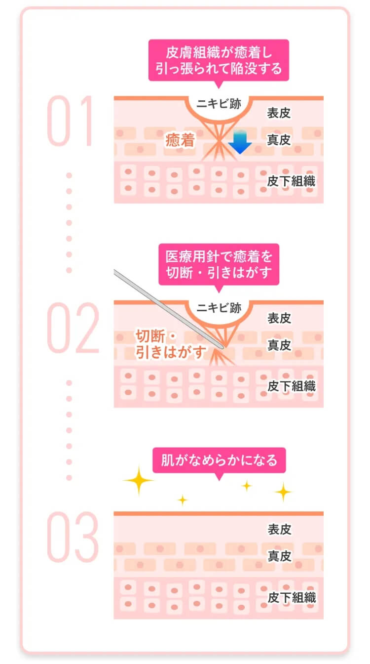 サブシジョンの仕組み