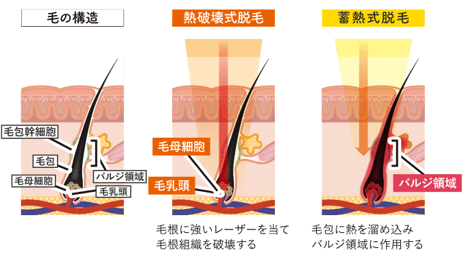 ヒゲ脱毛の仕組み