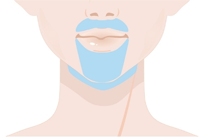 【メンズ脱毛】ヒゲ脱毛オーダーメイド